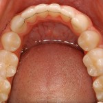 Orthodontic Retainer from Dublin Orthodontist
