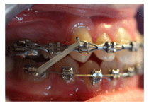 Fixed Metal Braces