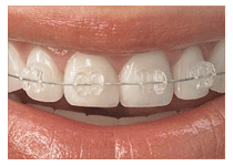 Fixed Clear Braces