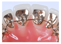 Lingual Braces